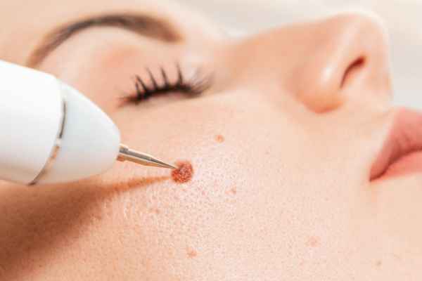 CryoPen: 5 Skin Concerns It May Be Used to Treat 3 What actually happens during a CryoPen treatment Worksop?